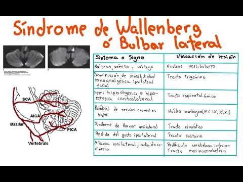 Síndrome de Wallenberg o bulbar lateral