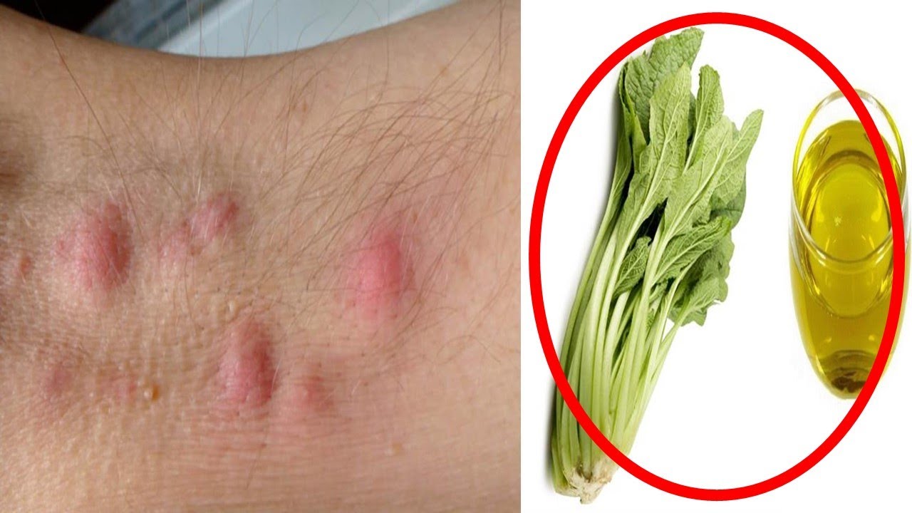 Remedios caseros para curar un golondrino en la axila_3