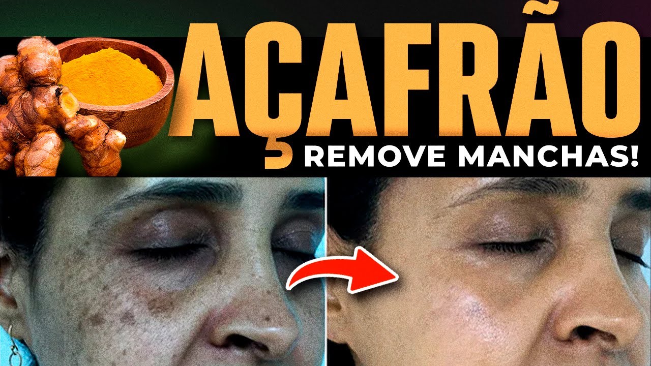 Como o Açafrão ESTICA RUGAS no Rosto e ELIMINA MANCHAS? Dr Renato ...