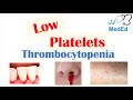 Thrombocytopenia | Signs and Symptoms and Approach to Causes