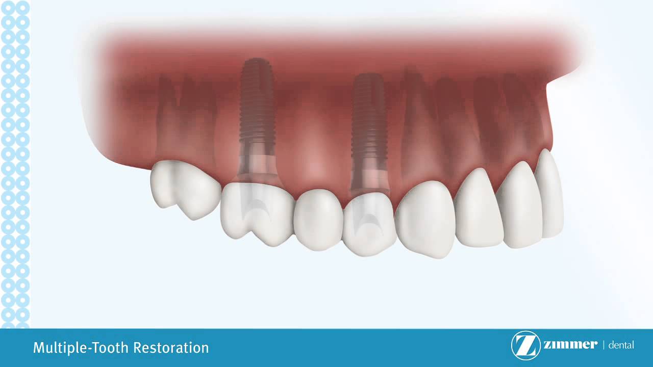 Replacing Multiple Missing Teeth With Dental Implants - YouTube