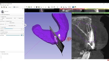STL and CBCT alignment (3d slicer with B4d) in Arabic