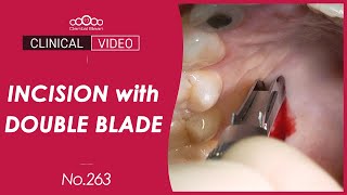 CTG on recessed lower anteriors by double blade - [Dr. Jeon Inseong]