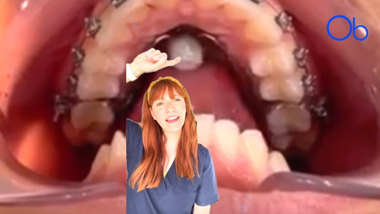 ¿Para qué sirve esta bolita en el paladar? 🔴 👄 Perla de Tucat YouTube ¿Para qué sirve esta bolita en el paladar? 🔴 👄 Perla de Tucat YouTube