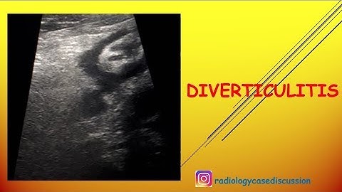 4-🪡🔪DIVERTICULITIS ♦️ ULTRASOUND AND CT FINDINGS