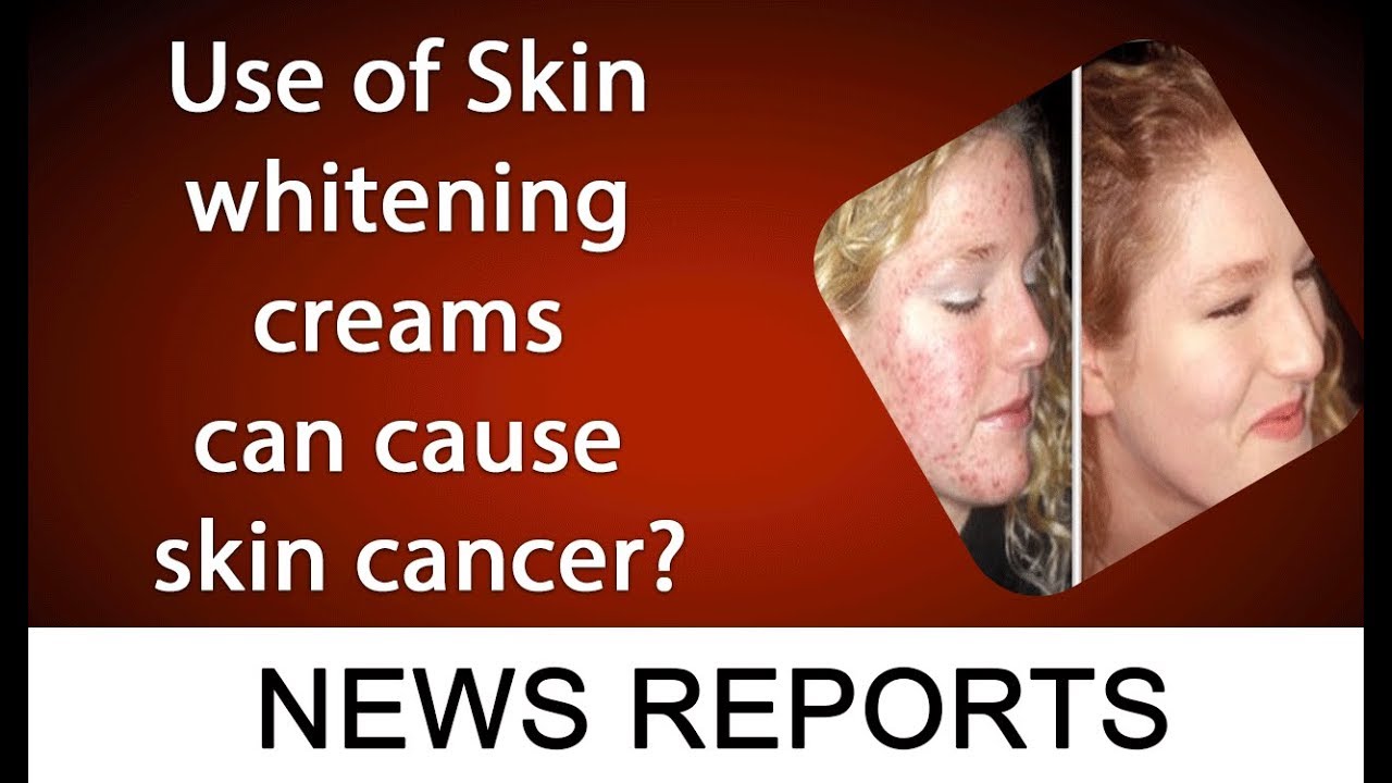 Use of Skin whitening creams can cause skin cancer? 22 May 2019