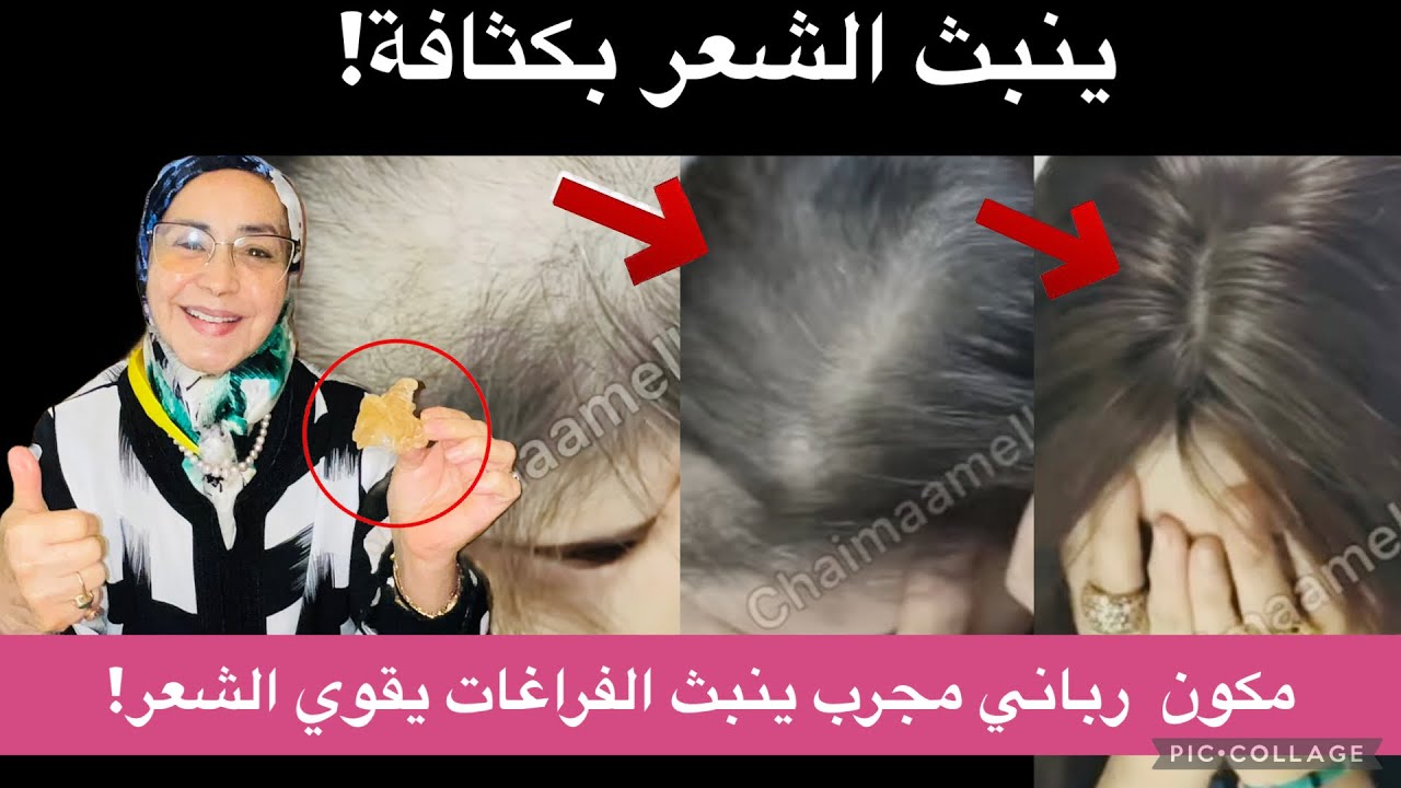 مكون معجزة ينبت فراغات الشعر ويوقف التساقط في وقت قياسي!