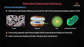 Adenosine deaminase (ADA) deficiency