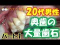 上尾 歯医者 歯周病 歯石取り(歯石除去) 20代男性 奥歯の大量歯石 Remove tartar　dentist　ตาด ขูดหินปูน เหงือกบวม