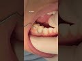 Composite veneer after root canal treatment of upper central tooth #UK #dental #dentist #dentalhealt