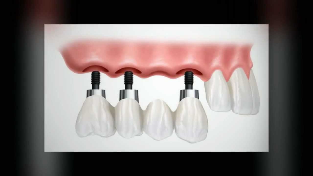 Dental Implants Baltimore MD Towson Parkville Carney Hampton