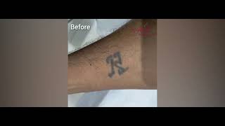 Laser Tattoo Removal Safe Effective Ink Fading At Alura Aesthetic Clinic