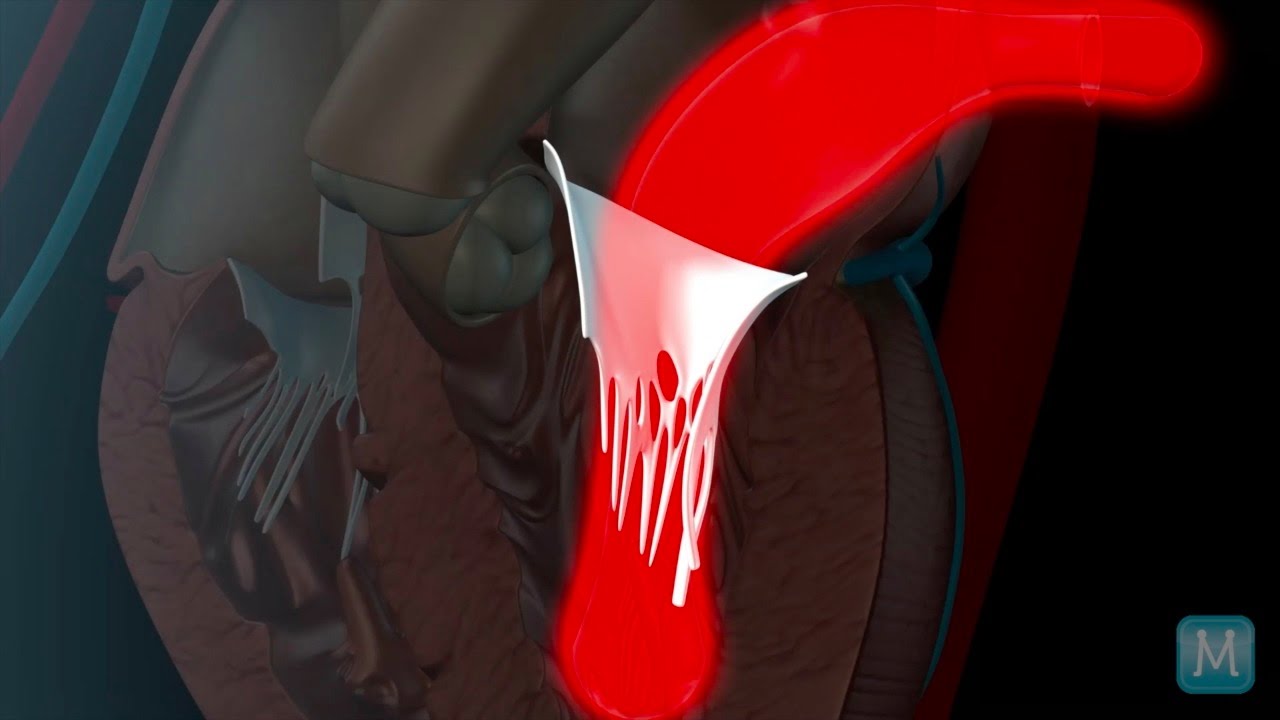 Mitral Valve Disease: Regurgitation and Stenosis | Match Health - YouTube