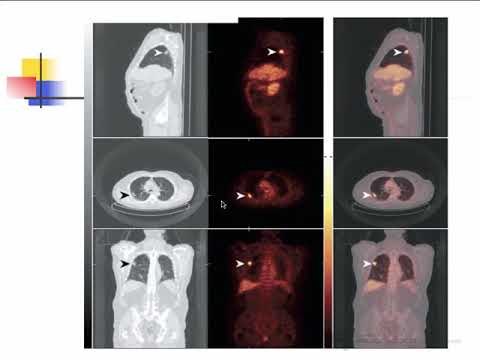 The Use of PET Scanning in Urologic Oncology