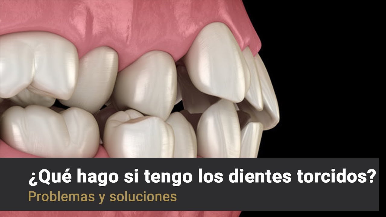 Carillas dentales con dientes torcidos? - Raga Ortodoncia