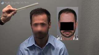 FUE Hair Transplant Result -1500 Grafts - Hair Transplant Results