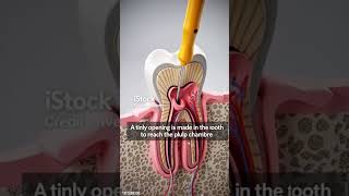 #RootCanal #DentalCare #ToothHealth #DentistTips #OralHealth #HealthyTeeth #Denta