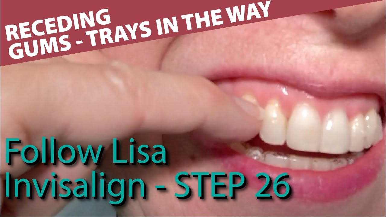 🦷 Invisalign 26 Receding gums adjustment on the top of the aligners