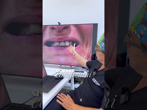 Video Un nuovo sorriso grazie allimplantologia e chirurgia computer guidata