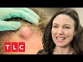 Beulen am Kopf | Dr. Emma: Hautärztin aus Leidenschaft | TLC Deutschland