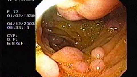 O que é neoplasia no duodeno?