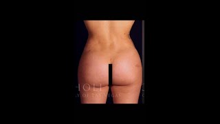Brazilian Butt Lift (BBL) Results from Dr. Samir Pancholi