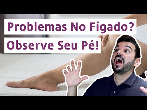 Vídeo: O fígado gordo pode causar eritema palmar?