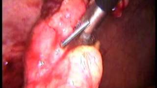 Video thumbnail of "laparoscopic appendicectomy"