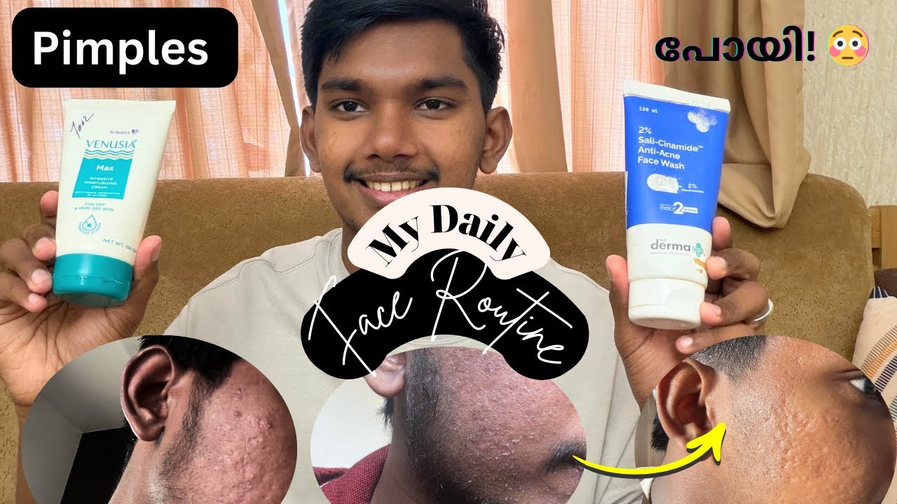 “എന്റെ Pimples എങ്ങനെ പോയി? 😳 | Real Routine”