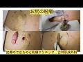 患者様の強い希望で載せてます。ピントズレてますがすいません。遅くなりすいません。ブログでも粉瘤について詳しく解説してます。皮膚のデキモノと粉瘤クリニック古林形成外科　東京新宿上野大阪梅田難波横浜札幌院