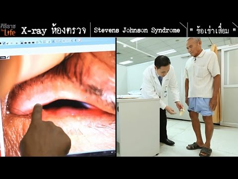 ศิริราช The Life [by Mahidol] ซีรีส์ x-ray ห้องตรวจ ตอน Stevens Johnson Syndrome และ ข้อเข่าเสื่อม
