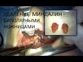Энергетическая тонзиллэктомия биполярными ножницами (ЛОР-хирургическая операция удаления миндалин)