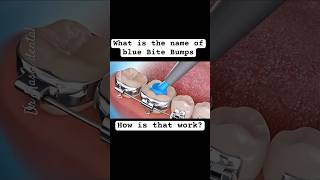 Bite Bumps, Bite Blockers Braces