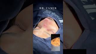 Resultado de rinoplastia ultrasónica | Armonía facial y naturalidad | Dr. Zamir Páez