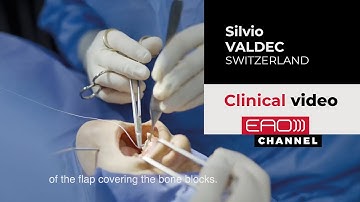 Customized Bone Regeneration With Allograft Onlay Blocks w/ Silvio Valdec | EAO Clinical video