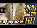 She’s Back! Lupus and the Feet Follow-Up: Shaving Thick Calluses