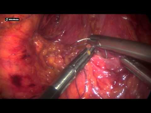 kidney transplant surgeon simulator animated kidney transplant surgeon simulator animated