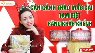 Vlog tháo niềng răng khấp khểnh - KH Phan Thu Thủy HN6013