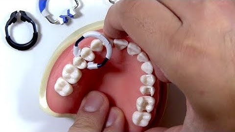 Guide to Picking the Correct Matrix Ring for Your Restoration with Dr. Brian Baliwas