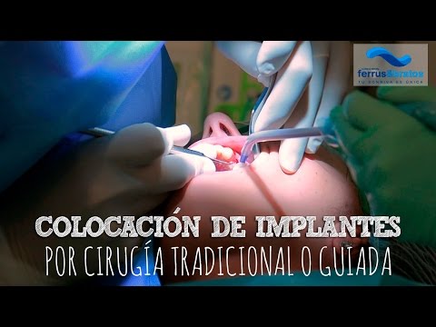 Colocación de implantes dentales