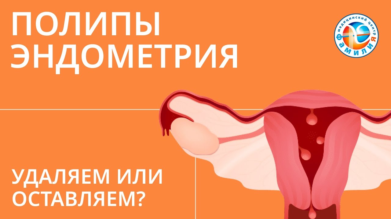 🤷 Полипы эндометрия. Удаляем или оставляем? - YouTube