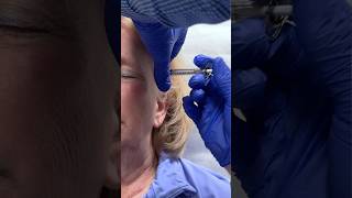 How Botox Can Help With Chronic Migraine @rushmedicalcenter