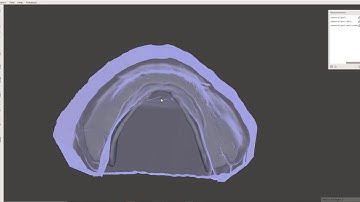 Making Custom Impression Trays That Also Serve As Record Bases