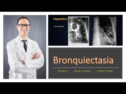 Vídeo: Bronquiectasia: Causas, Sintomas E Diagnóstico