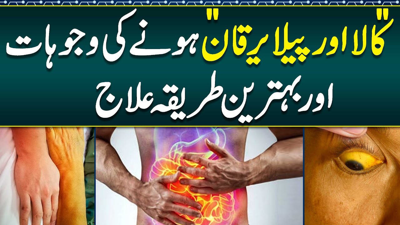 Treatment of Yellow Fever- Jaundice Causes \u0026 Treatment- How to Cure Jaundice- Fatty Liver Causes ...