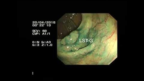 Piecemeal EMR of caecal LST