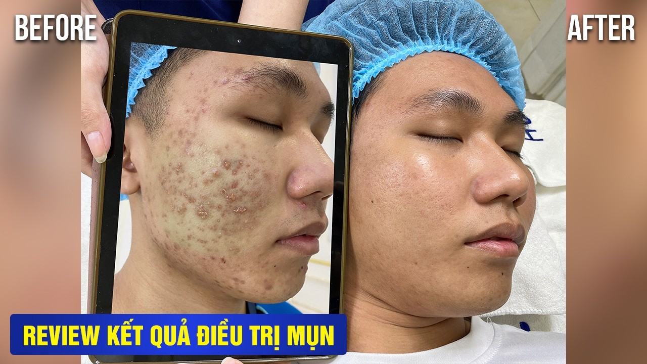 CÔNG NGHỆ LASER PIXEL MASTER – CHẤM DỨT “VÒNG LẶP” MỤN VIÊM DAI DẲNG 7-8 NĂM.