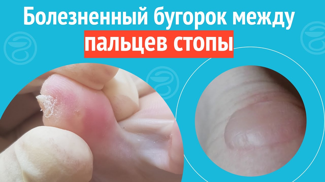 🦶 Болезненный бугорок между пальцев стопы. Клинический случай №1113