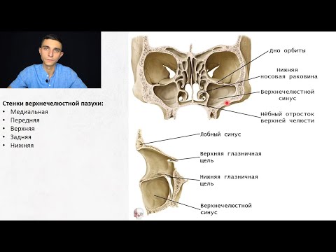 Гаймориты, гайморотомия по Caldwell Luc