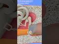 Ear Tube Placement (TympanostomyTubes) 3D Animation #ear #tube #eartubes #placement #tympanostomy